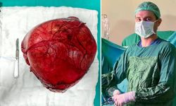 Devlet Hastanesi’nde Nadir Görülen Dev Kitle Başarıyla Alındı