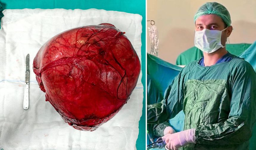 Devlet Hastanesi’nde Nadir Görülen Dev Kitle Başarıyla Alındı
